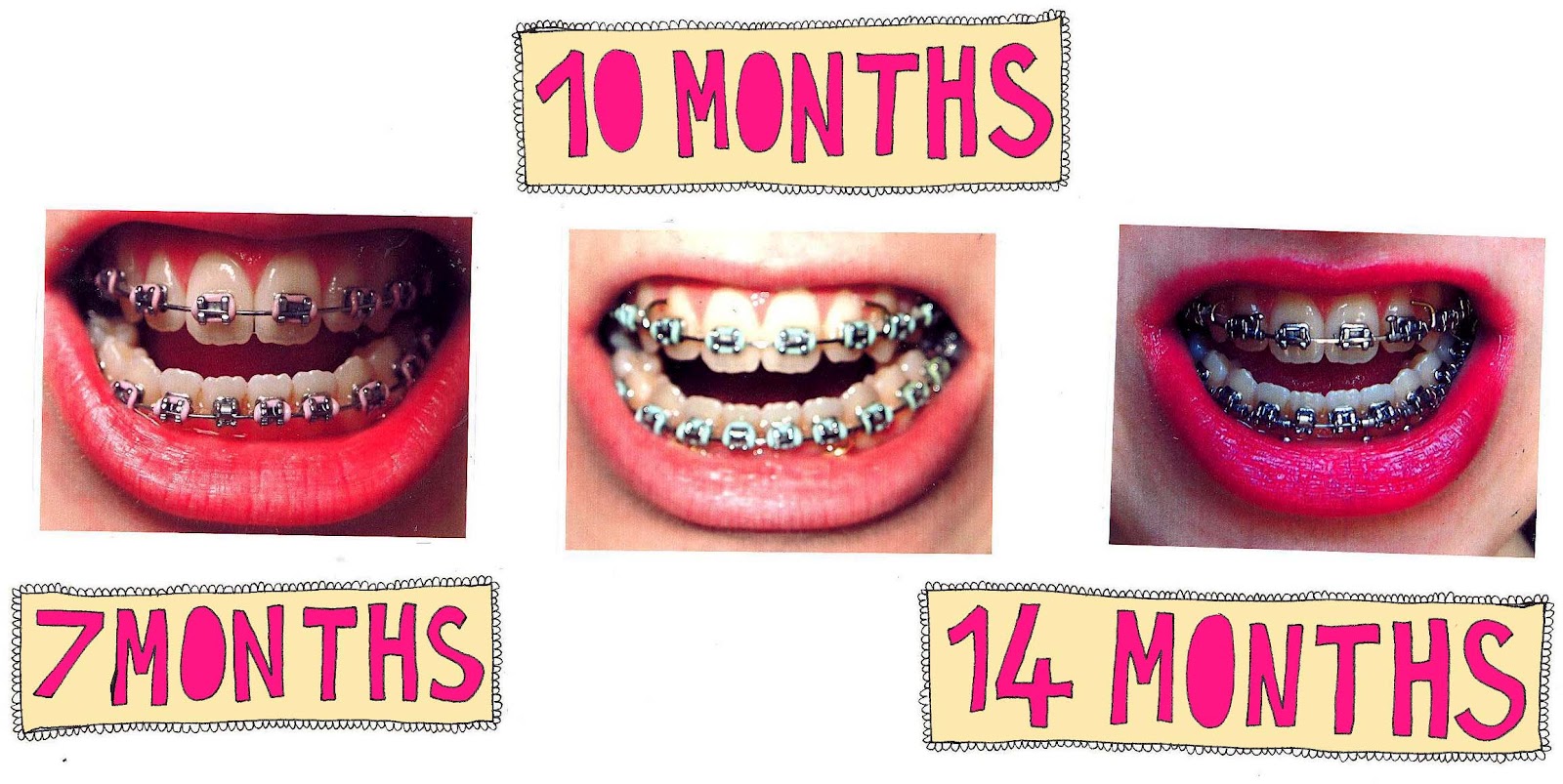 Rosa's Jaw Surgery Story My Journey in Braces