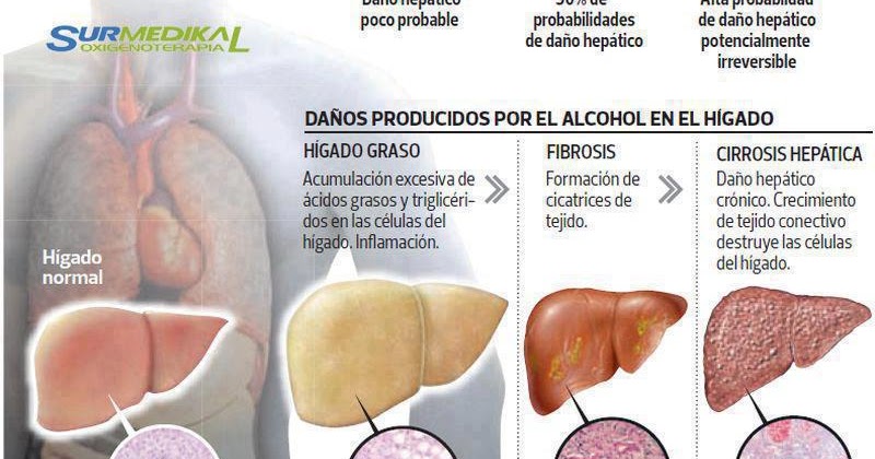 Trattamento di carbonato di sodio di alcolismo su un neumyvakina