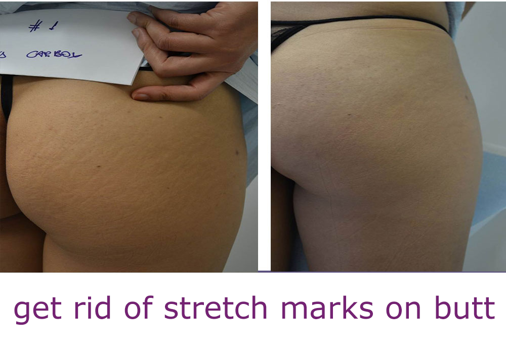 Does Mederma work for stretch marks?