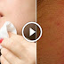 How Remove Pimples