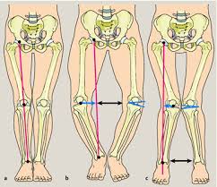 Rakitis, Pengertian Penyakit, Rakititis, Tanda dan Gejala Rakitis