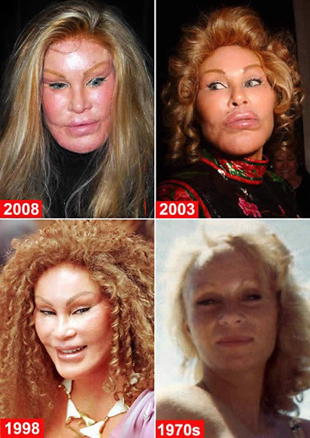 Nicki Minaj Plastic Surgery Before And After Pictures. Nicki Minaj before and after
