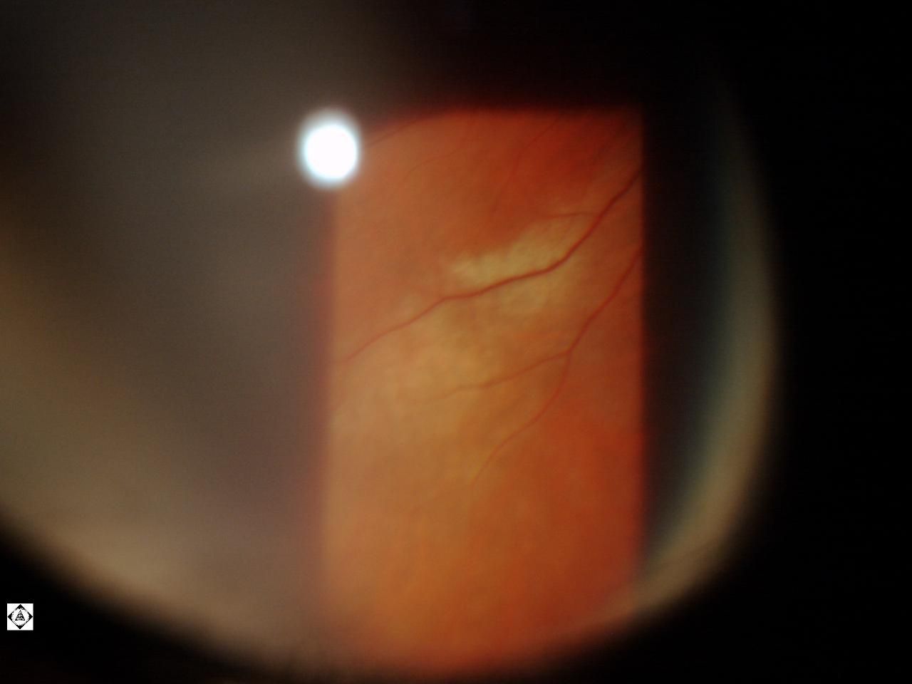 Sonoran Desert Eye Center COMMOTIO RETINAE Sonoran Desert Eye Center COMMOTIO RETINAE