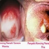 Penyakit Kencing Nanah Pria Dan Wanita Penyakit Kencing Nanah Pria Dan Wanita