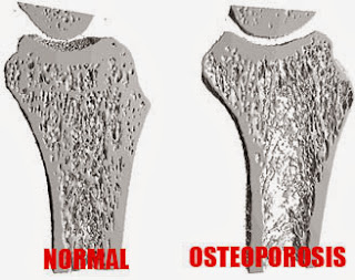 Role of Serotonin Overcome Osteoporosis