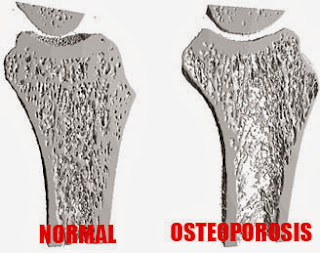 medical journal articles osteoporosis medical journal articles osteoporosis