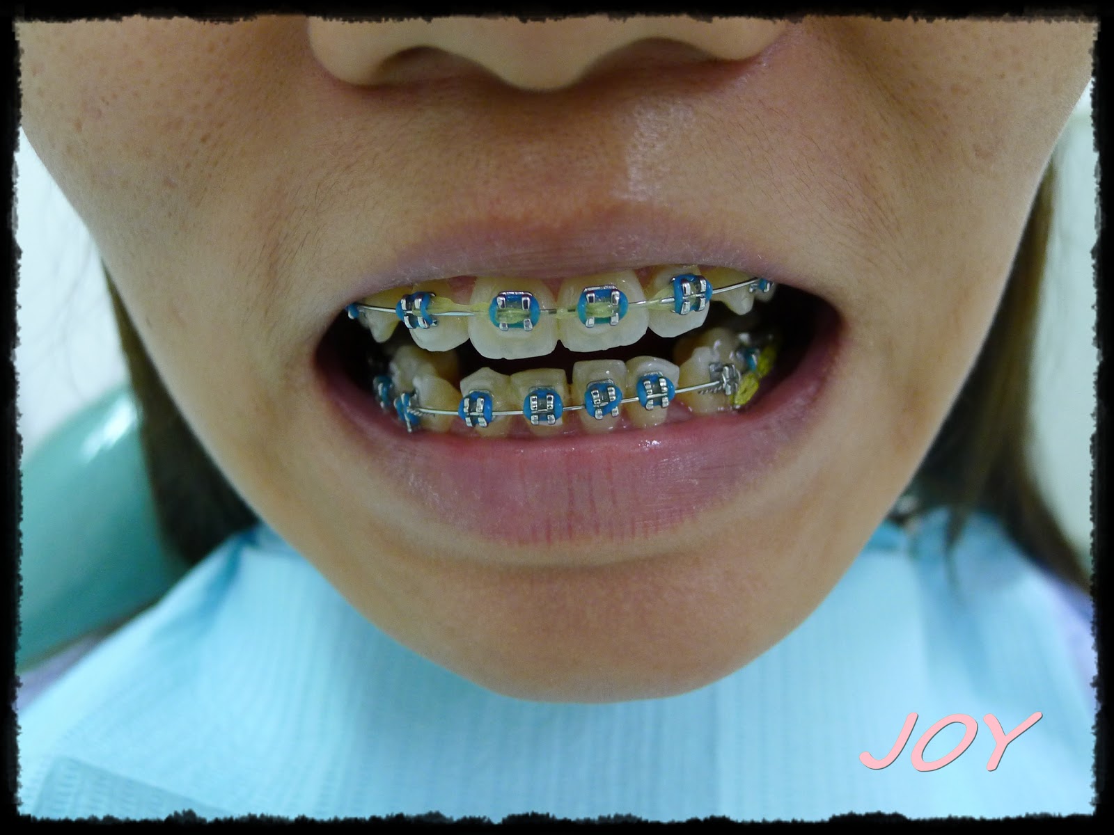Dental BracesChanging the ORing Rubber Pink [again] ♥J.O.Y♥