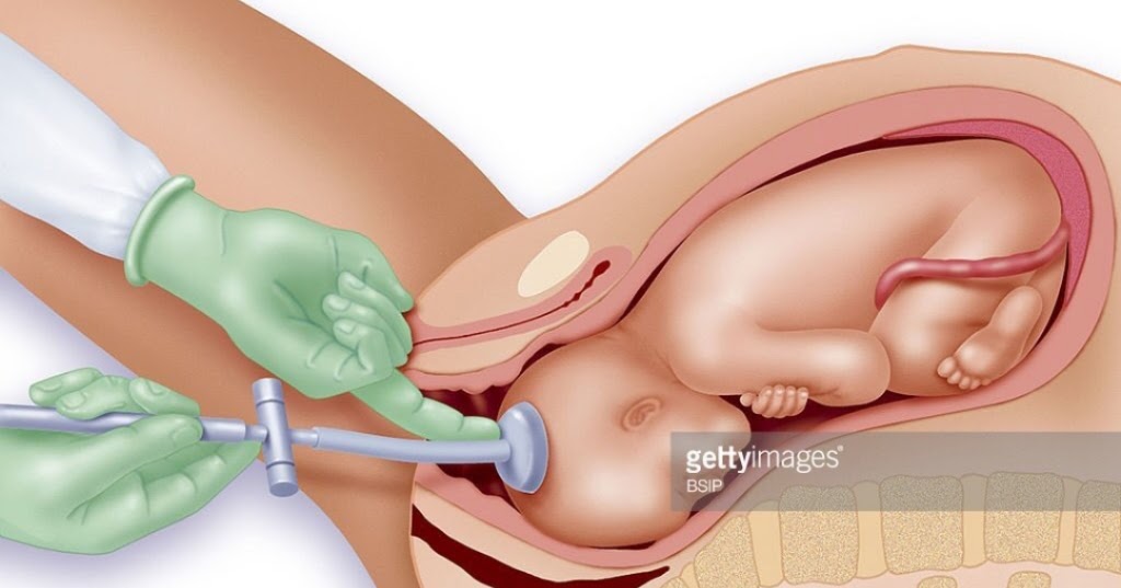 Вибратор После Родов