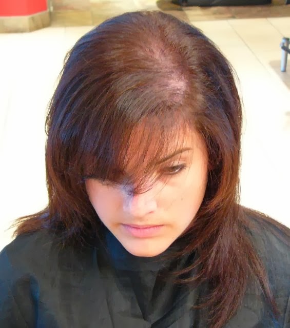 Does natural progesterone stop hair loss in women? Slim Hair Beauty