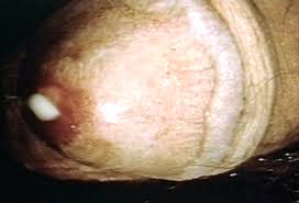 Cara Menyembuhkan Penyakit Gonorrhea Cara Menyembuhkan Penyakit Gonorrhea