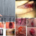 Ciri-Ciri Wasir (Hemoroid) Berdarah Pada Wanita thumbnail