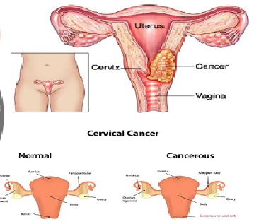 Advertencia - usted nunca debe ignorar las señales más comunes de cáncer de cuello uterino Advertencia-usted-nunca-debe-ignorar-las-señales-más-comunes-de-cáncer-de-cuello-uterino