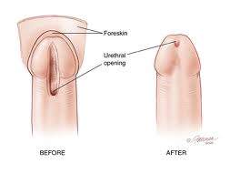 gender reassignment surgery results
