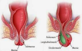 wasir obat herbal wasir