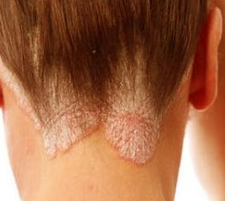 Psoriasis Do You Know The Symptoms Of Psoriasis?