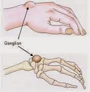 Pengobatan Alami Kista Ganglion
