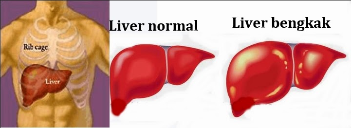Penyakit Liver Penyakit Liver