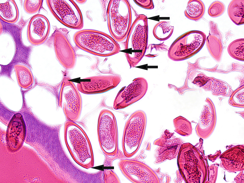 Herpes - Herpes Pictures and Cold Sores Pictures Herpes - Herpes Pictures and Cold Sores Pictures