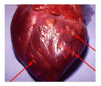 MYOCARDITIS MYOCARDITIS