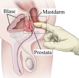 examen de prostata