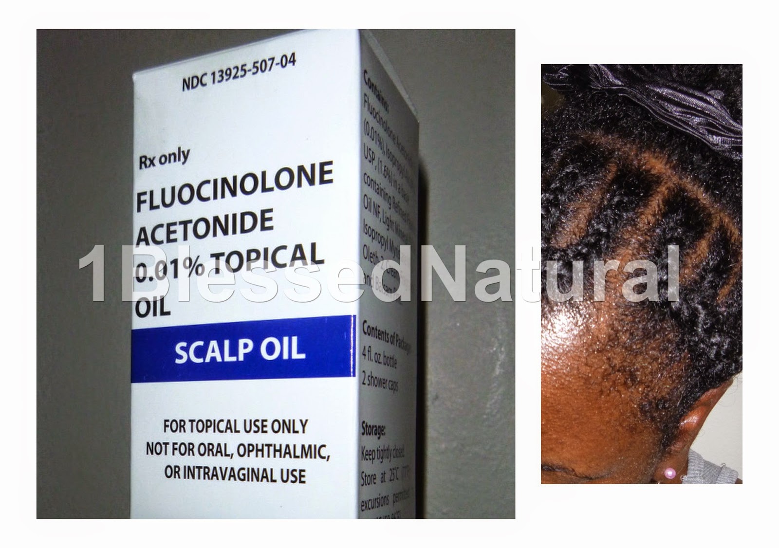 is fluocinolone acetonide oil a steroid