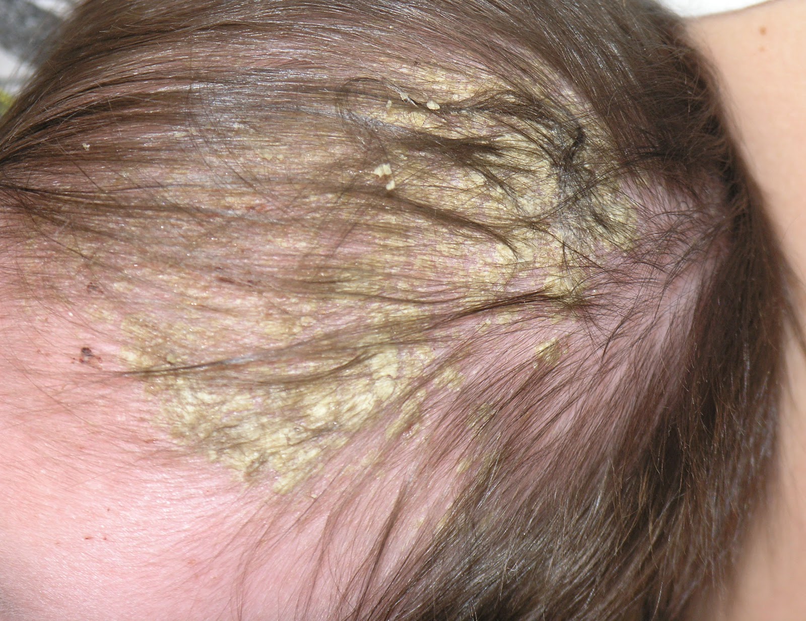 flaky scalp