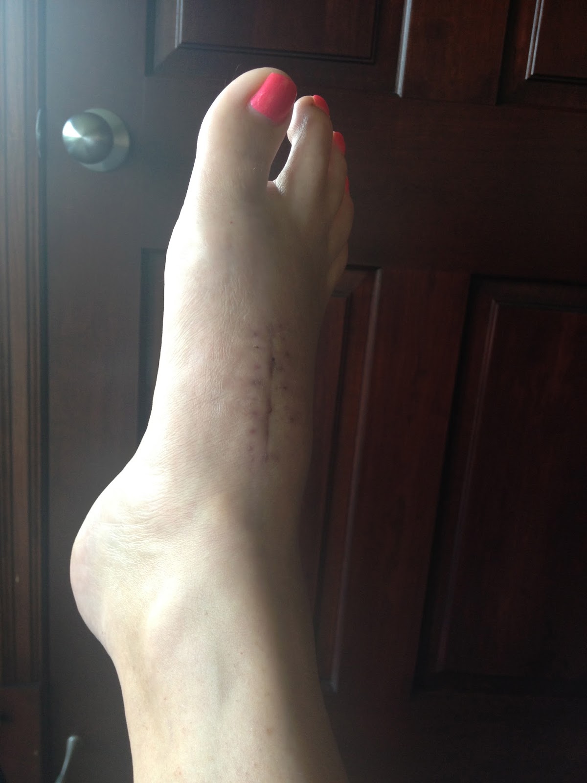 After LisFranc Surgery 5 weeks post lisfranc surgery