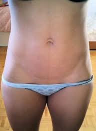 hot line care why do stretch marks form how do stretch marks form