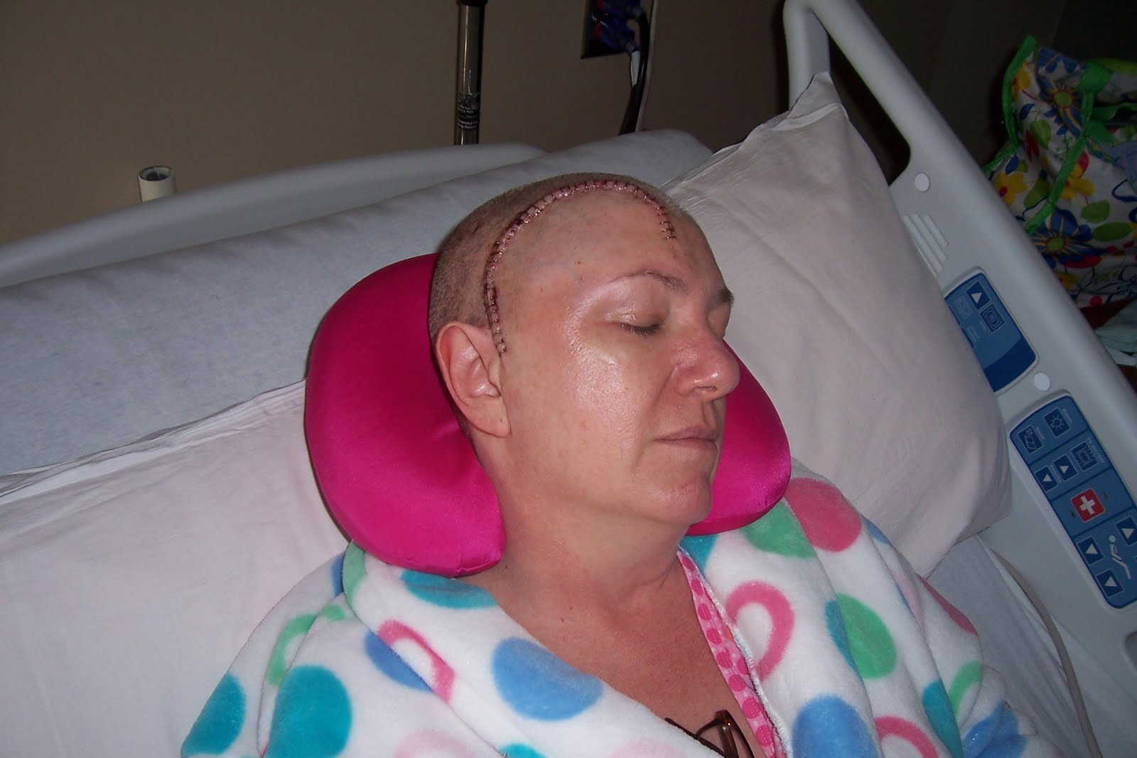 Aneurysm Brain Surgery