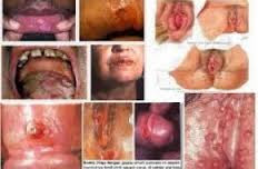 Penyembuhan SIpilis Raja Singa Penyembuhan SIpilis Raja Singa