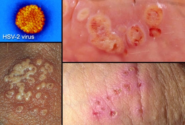 Best Way to Reduce Genital Herpes Transmission