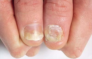 Medicine per cura di psoriasi di una parte pelosa della testa