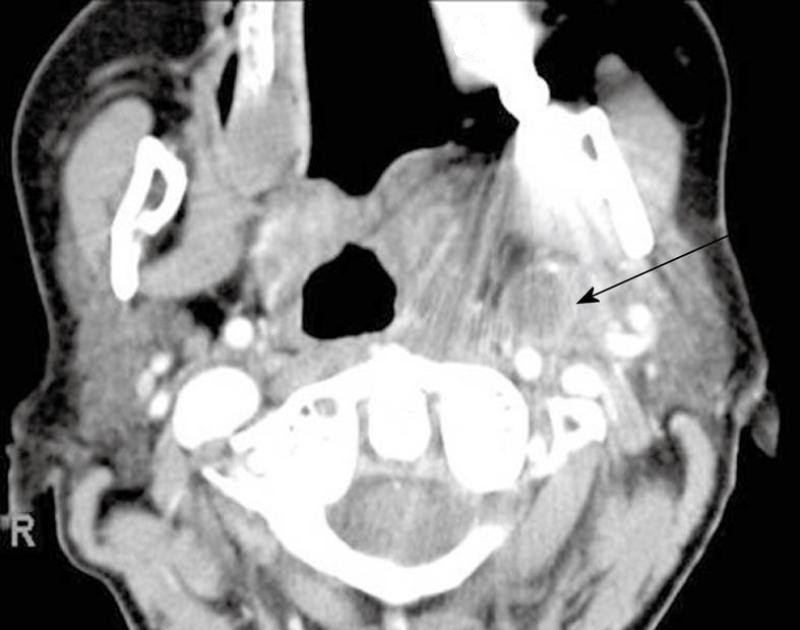 ABC Radiology Blog Parapharyngeal Abscess