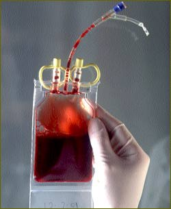 LEUCEMIA LINFOCITICA AGUDA Y leucemia linfocitica aguda y: