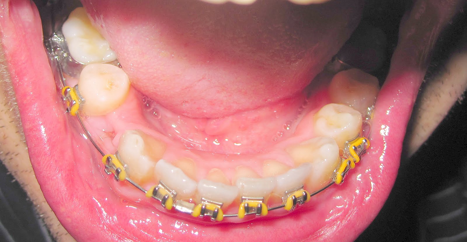 teeth spacers bottom better loose feel felt anymore worth week extractions neighboring were