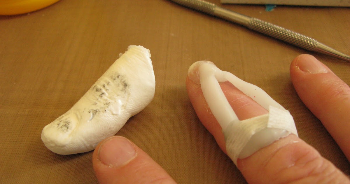 v12 and finger casts 53 days