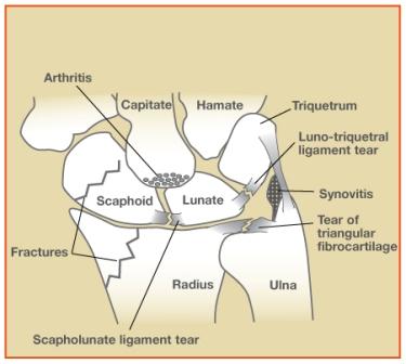 Tfcc Ligament Tear Repair