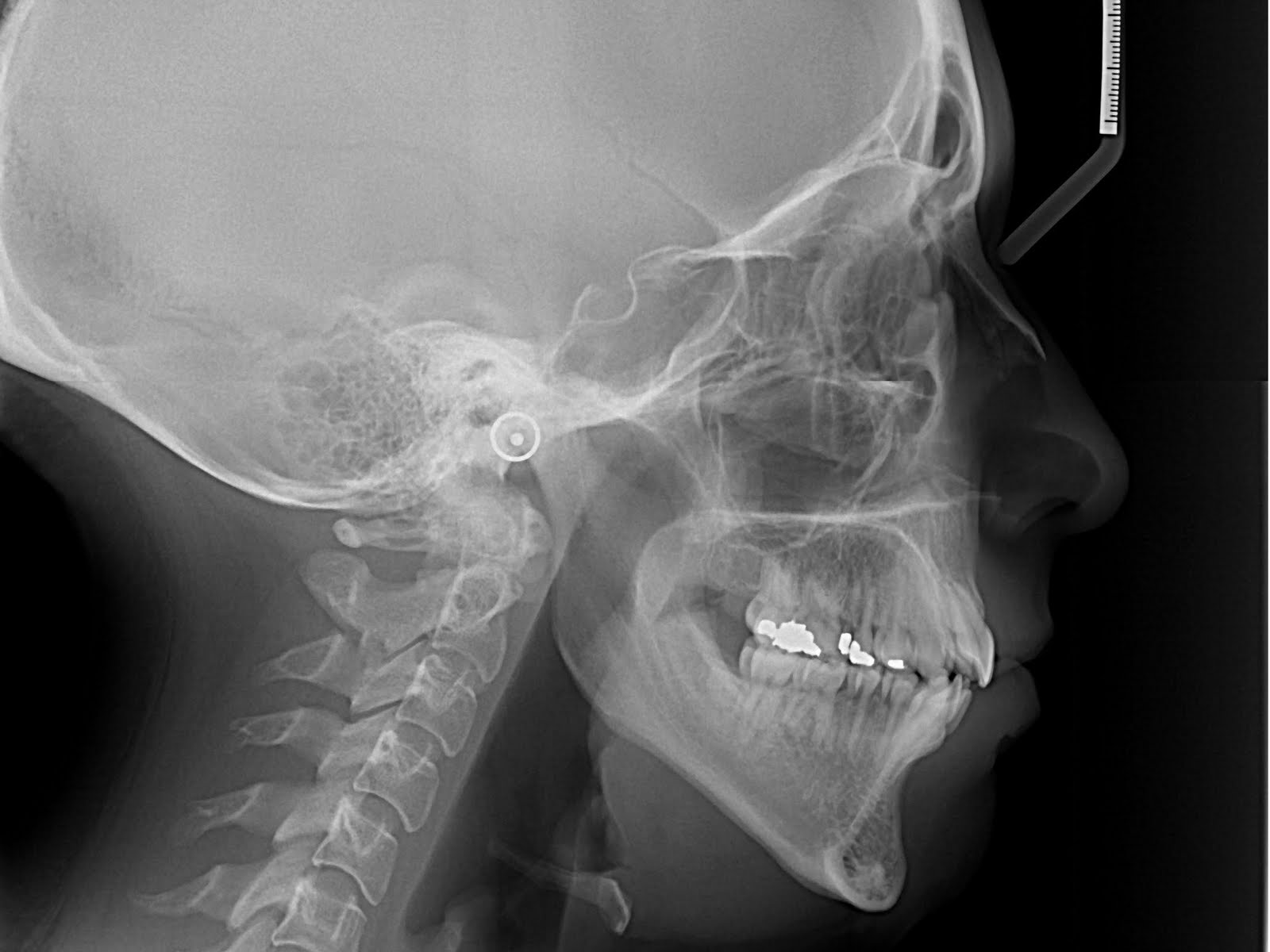 steph's jaw surgery blog xrays