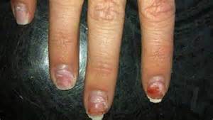 Pro Nail Tech Training Mma Methyl Methacrylate When Designing A Nail Enhancement Product My Premiere Goal Is To Make The Weaker Than Natural Prevent Serious Plate Damage Mma