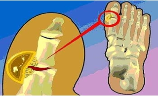 La osteocondrosis del vídeo a sheynom la osteocondrosis del ejercicio del vídeo