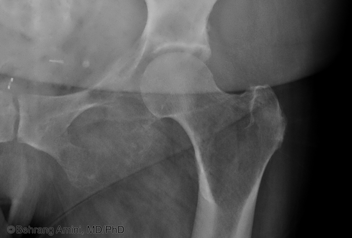 Intertrochanteric Fracture Mirels Classification for Risk of Pathological Fracture-4.bp.blogspot.com