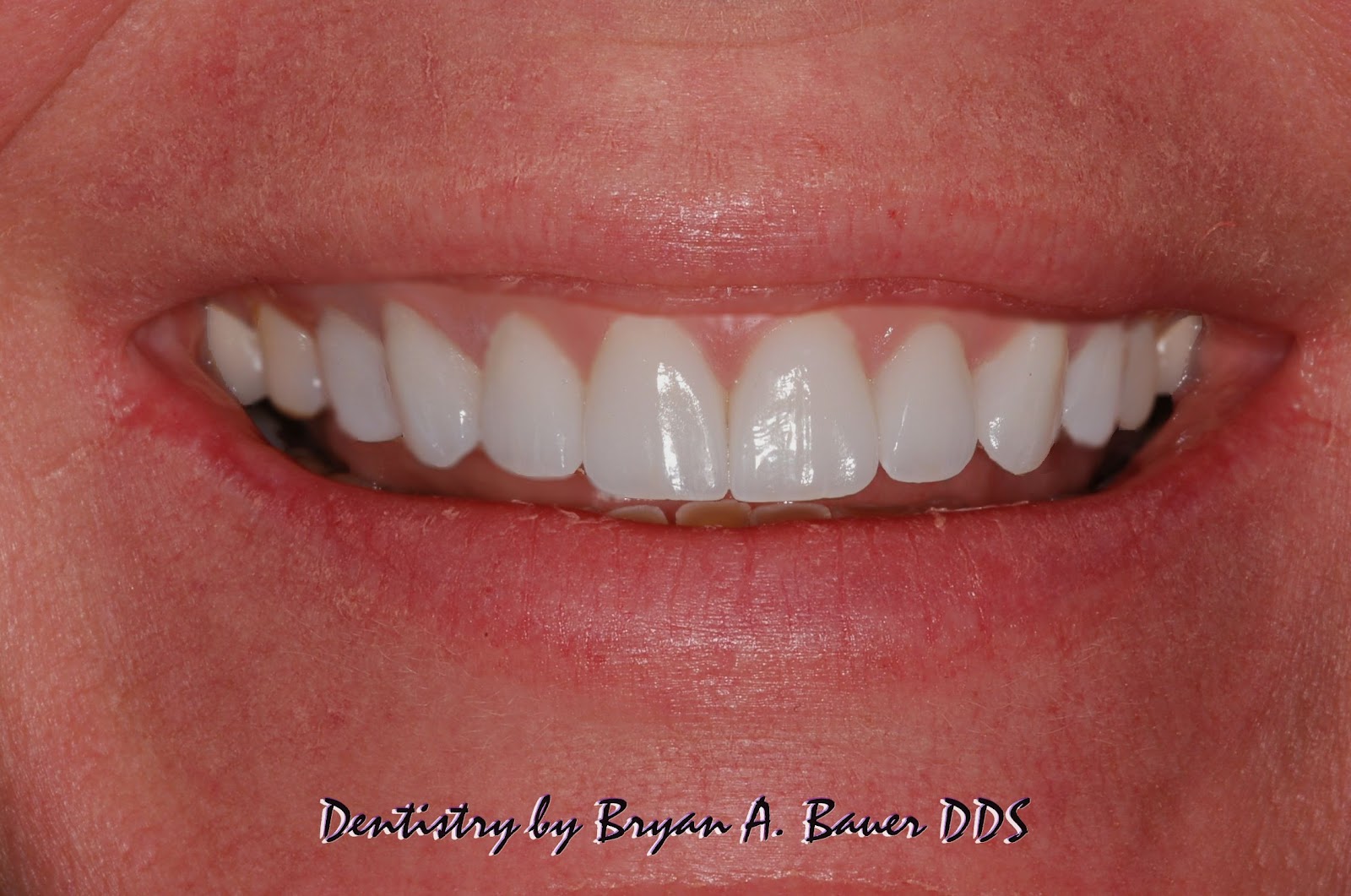 Ground down teeth? Bauer Smiles