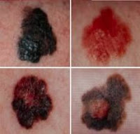 Tipos de cáncer de piel - Spotting melanoma cáncer de piel y de carcinoma , los síntomas de cáncer de piel , el tratamiento para el cáncer de piel, cáncer de piel , melanoma , carcinoma