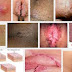 Obat Perontok Kutil Kelamin thumbnail