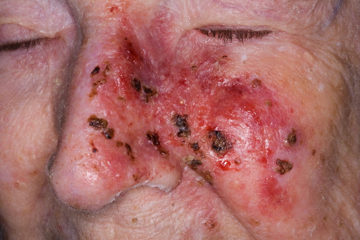 Red Skin Cancer