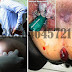 Wasir (Hemoroid) Luar Pecah, Bagaimana Solusinya thumbnail