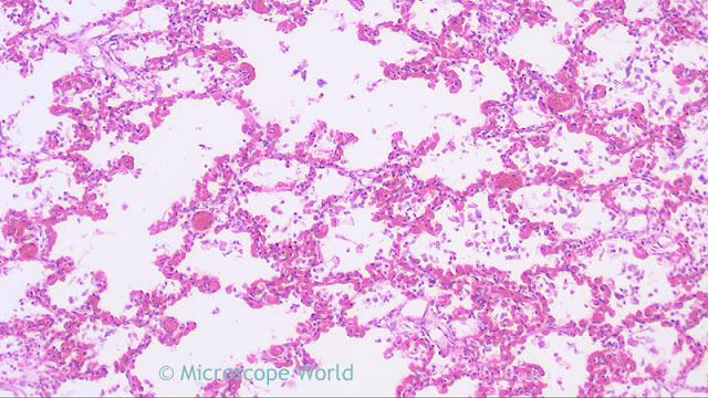 Microscope image of pneumonia captured at 100x under a clinical lab microscope.