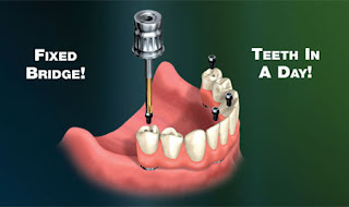 Teeth in a Day Houston Teeth in a Day Houston