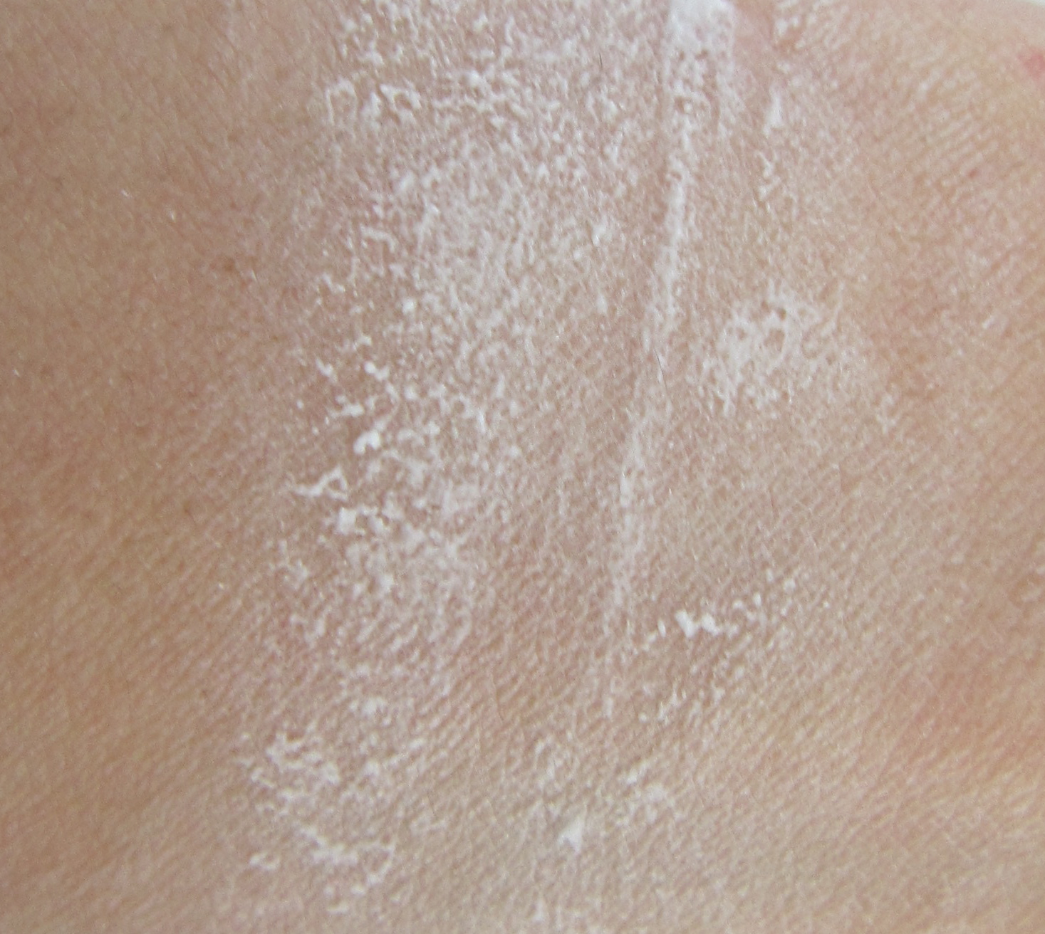 Sunburn Scars