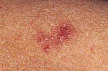 Macam-macam Penyakit Herpes.